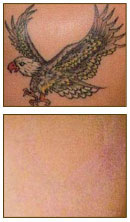 Tattoo Removal