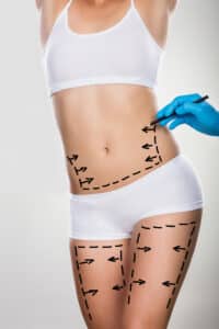 Tummy tuck procedure