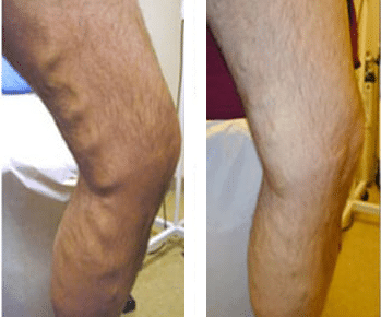 Before/After Spider Vein Treatment