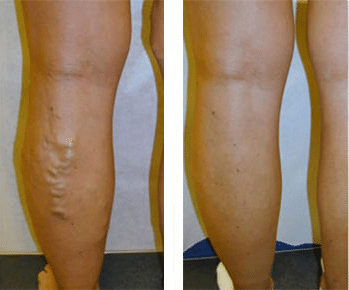 Varicose Veins Before/After