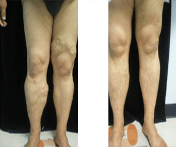 Before Varicose Vein Treatment-1