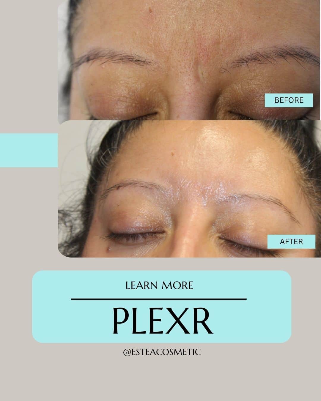 Before and after results of a Plexr treatment. 