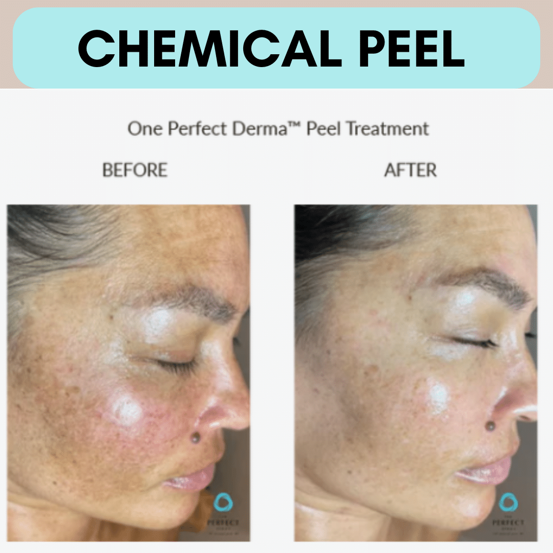 Before and after results of our Dermapeel treatment that targets wrinkles, acne scars, acne, skin pigmentation, and skin texture.