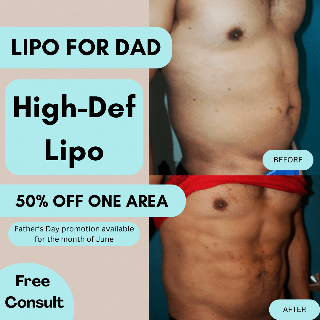 Client Testimonial: Before and After results of a high-definition liposuction patient.