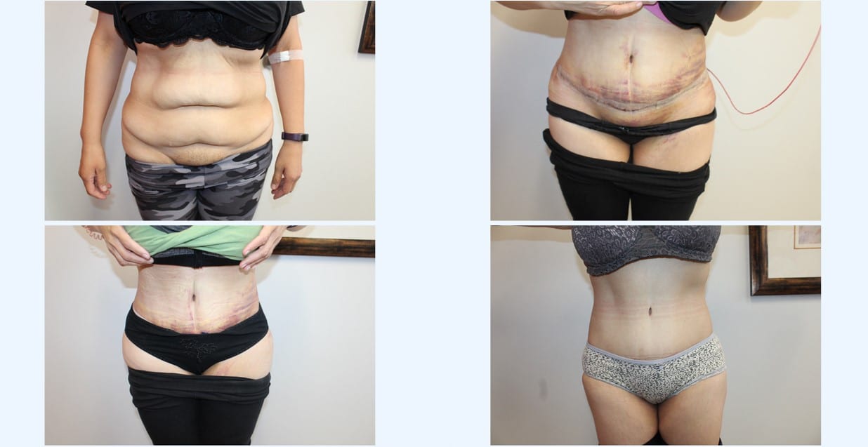 Tummy tuck healing process