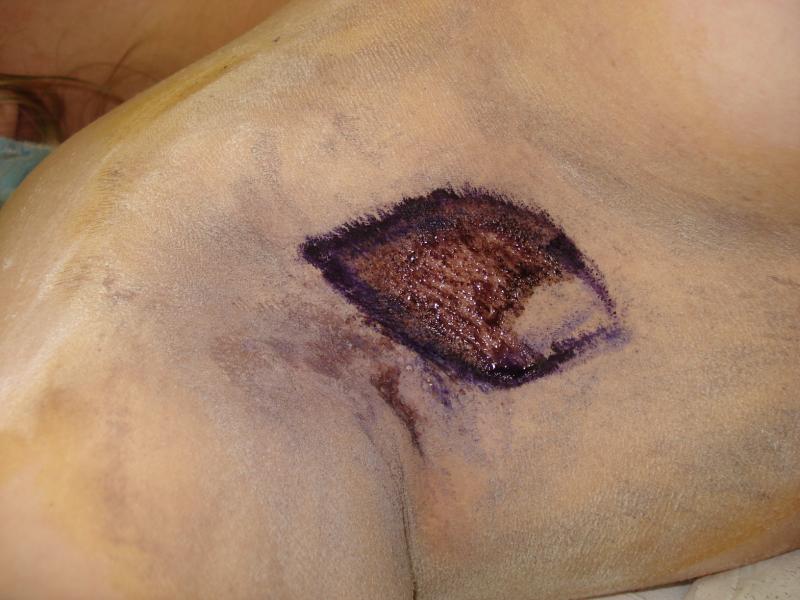 axillary hyperhydrosis 1