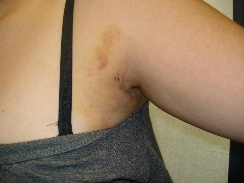 axillary hyperhydrosis 2