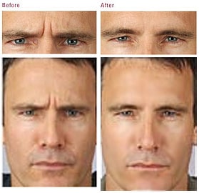 before after1