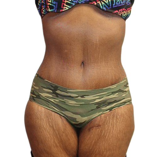 After Image: Tummy Tuck - front