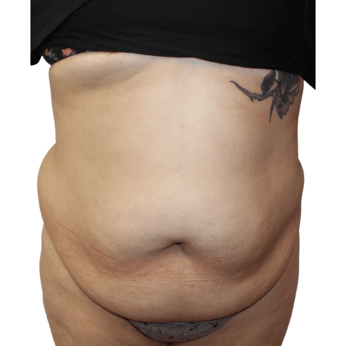 Before Image: Tummy Tuck - front