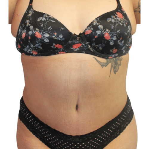 After Image: Tummy Tuck - front