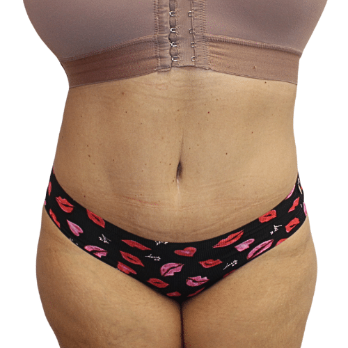 After Image: Tummy Tuck - front