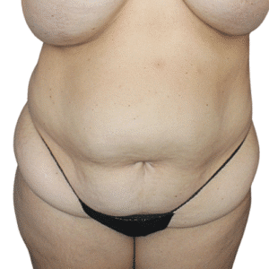 Before Image: Tummy Tuck