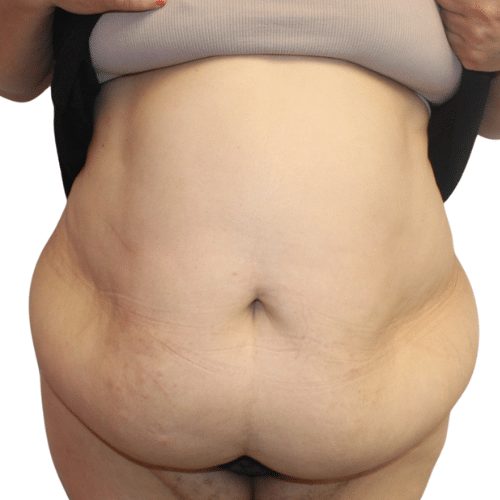 Before Image: Tummy Tuck - front