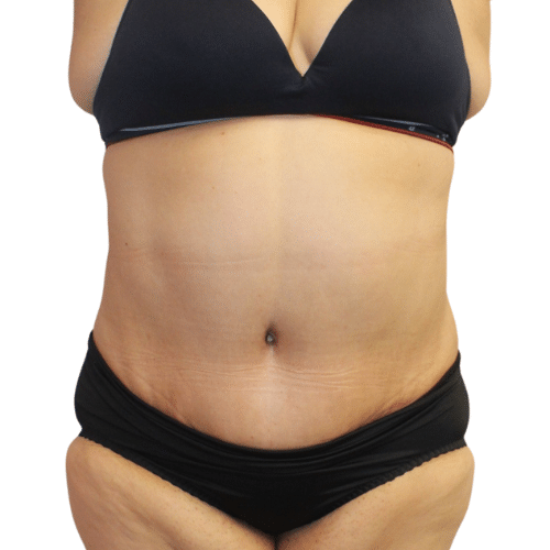 After Image: Tummy Tuck - front