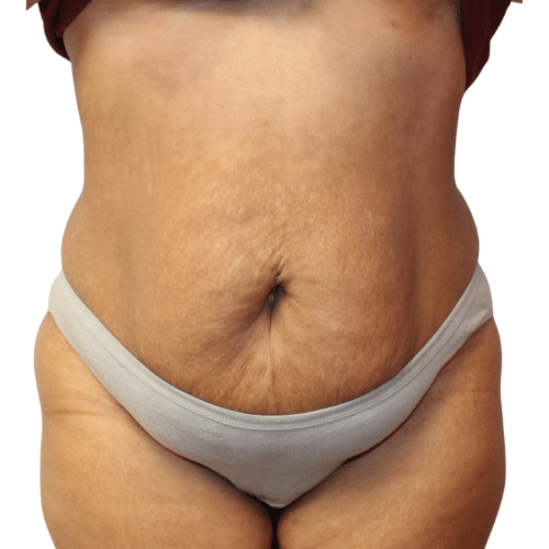 Before Image: Tummy Tuck - front