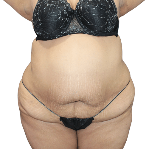Before Image: Tummy Tuck - front