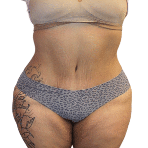 After Image: Tummy Tuck