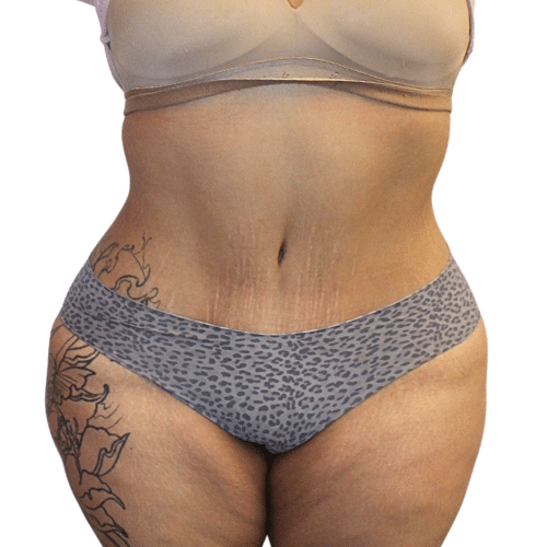 After Image: Tummy Tuck - front