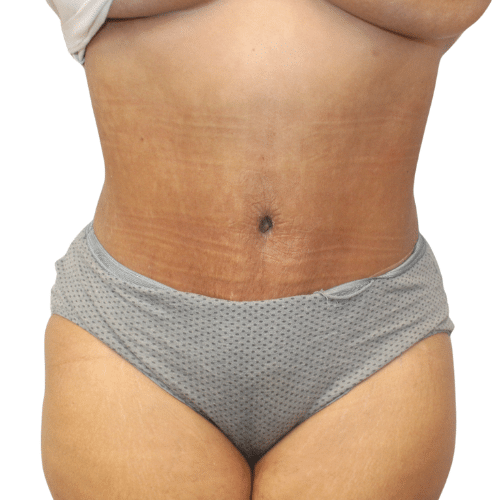 After Image: Tummy Tuck - front