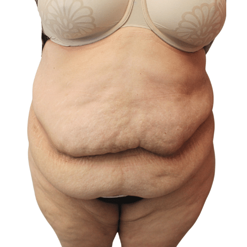 Before Image: Tummy Tuck - front