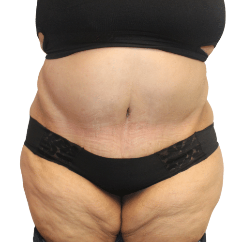 After Image: Tummy Tuck - front