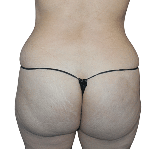Before Image: Fat Transfer to Glutes - back