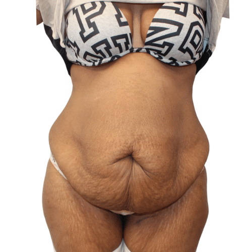 Before Image: Tummy Tuck - front