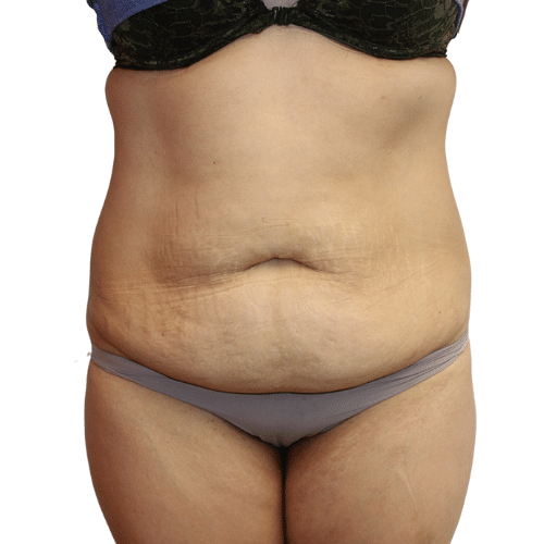 Before Image: Tummy Tuck - front
