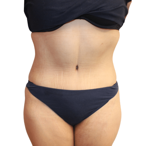 After Image: Tummy Tuck - front