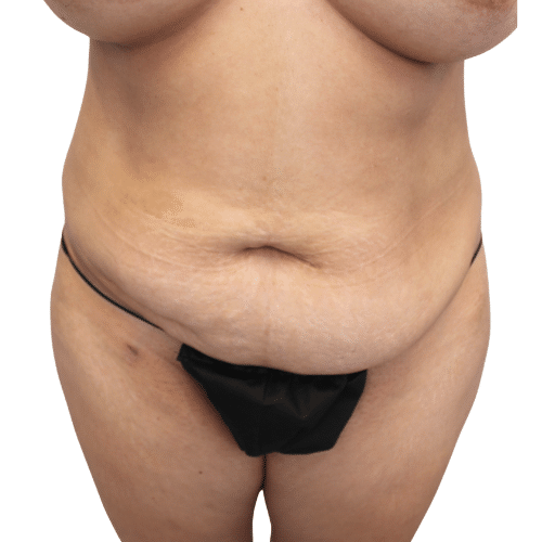 Before Image: Tummy Tuck - front