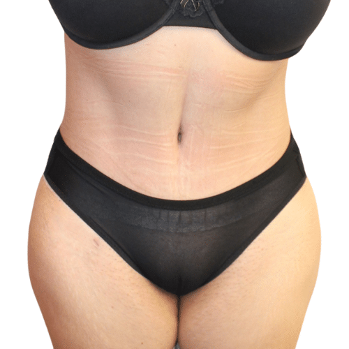 After Image: Tummy Tuck - front