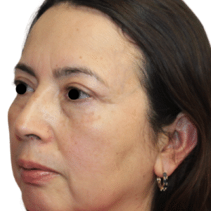 After Image: Upper Blepharoplasty