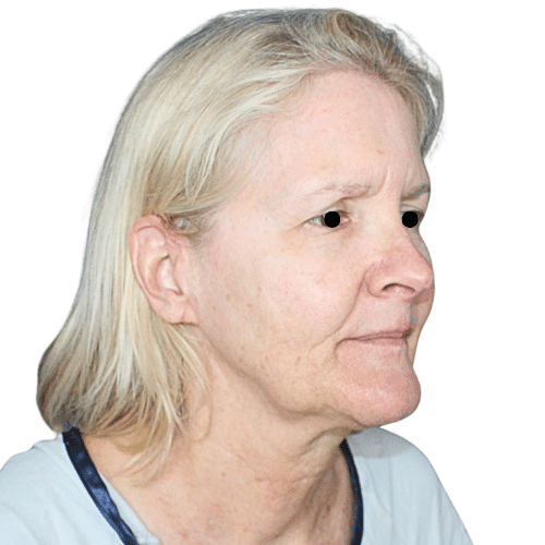 Before Image: Face/Neck Lift - right-front-oblique