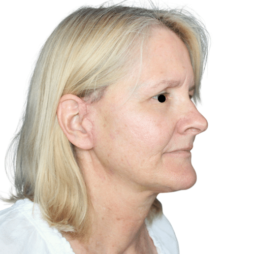 After Image: Face/Neck Lift - right-front-oblique