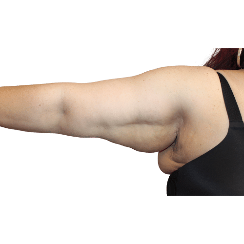 Before Image: Brachioplasty/Arm Lift - front