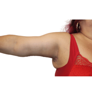 After Image: Brachioplasty/Arm Lift