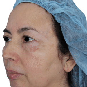 Before Image: Upper Blepharoplasty