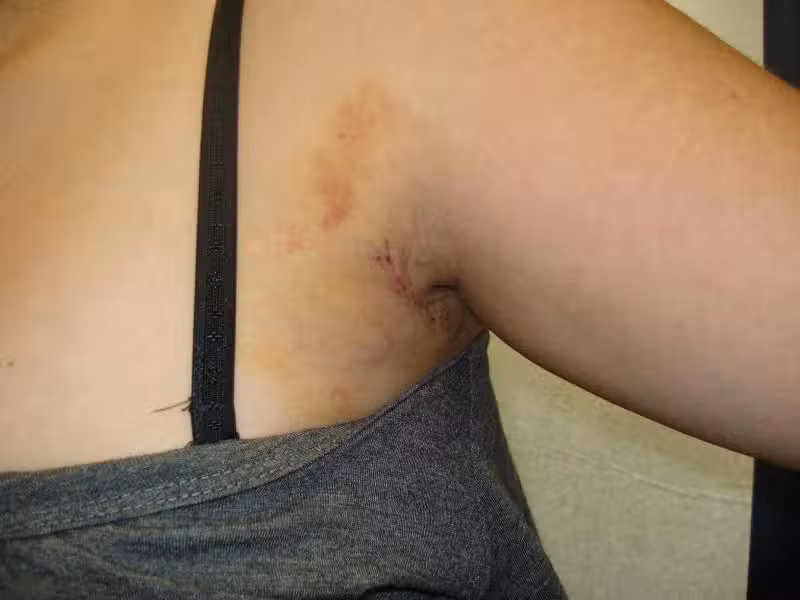 axillary-hyperhydrosis-2.jpeg