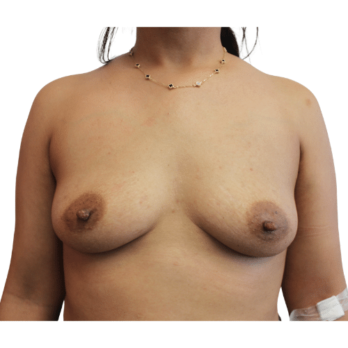 Before Image: Breast Augmentation - front