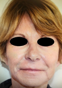 After Image: Fat Transfer to Face - front