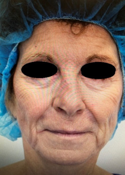 Before Image: Fat Transfer to Face - front