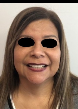 After Image: ALMI procedure - front