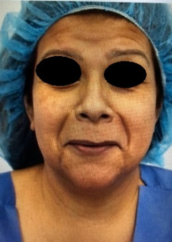 Before Image: ALMI procedure - front