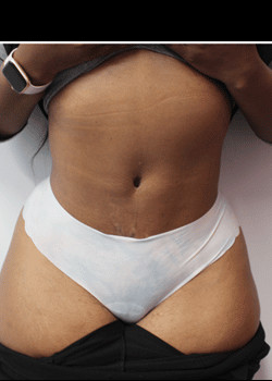After Image: Tummy Tuck - front
