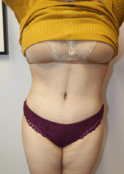 After Image: Tummy Tuck - front