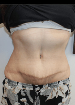 After Image: Tummy Tuck - front