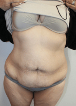 Before Image: Tummy Tuck - front