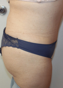 After Image: Tummy Tuck - left-side