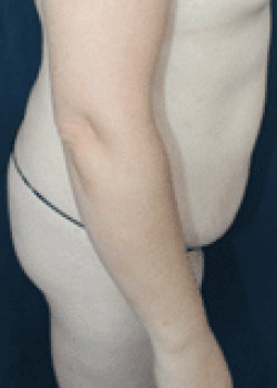 Before Image: Tummy Tuck - left-side